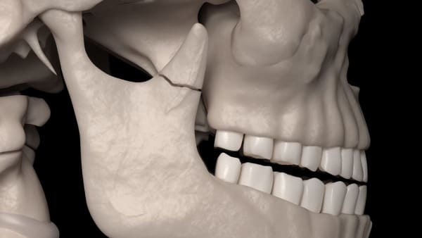 fracture machoire chirurgie du visage paris chirurgien maxillo facial paris docteur charles mathieu bandini paris 17