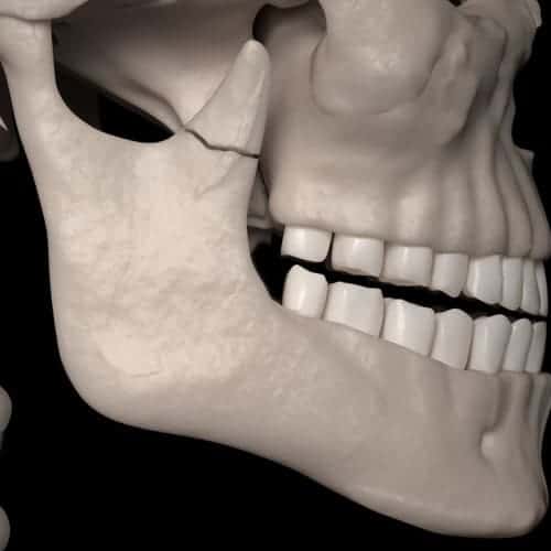 fracture machoire chirurgie du visage paris chirurgien maxillo facial paris dr charles mathieu bandini paris 17