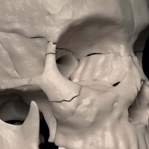 fracture zygoma chirurgie du visage paris chirurgien maxillo facial paris dr charles mathieu bandini paris 17